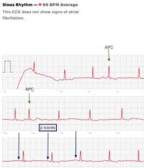 If you experience frequent episodes of pvcs, it's important to try to. Premature Atrial Contractions Benign Or Malignant Medpage Today