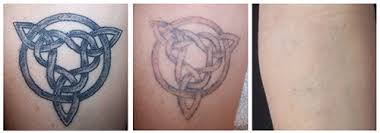 You may feel a sensation that feels like a rubber band being snapped on your skin. Laser Tattoo Removal Jupiter Miami Fl Tattoo Removal