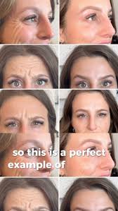 🚨 BIG NEWS 🚨 Our girl Tegan has officially lost her Botox virginity—and  she did it in style! 💉✨ Three areas tackled: frown lines, forehead, and  those little crow’s feet that were just starting to get ...