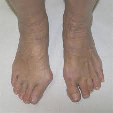 Severs sykdom er en traksjons apofysitt på calcaneus ved innfestningen til akilles senen. Hallux Valgus Medibas