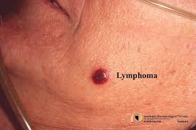Image result for Lymphoma