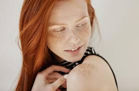 Image result for Vitiligo