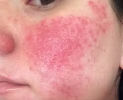 Her Rosacea Was So Bad She Didn T Want To Look In The Mirror You Should See Her Now Rosacea Look In The Mirror Skin Treatments