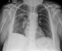 A loculated pleural effusion is the major radiographic hallmark of parapneumonic effusion or empyema (see fig. Parapneumonic Effusion Loculated Radiology Case Radiopaedia Org