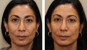 Nasolabial folds are a distinct marker of aging. Before After Restylane Injections Dermal Fillers Dr Mccracken