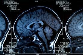 Demens er en fellesbetegnelse på sykdommer som fører til tap av intellektuelle funksjoner på grunn av økt svinn av hjerneceller. Trening Alzheimer Alzheimer Er Den Sykdommen Nordmenn Frykter Mest Slik Halverer Du Risikoen For A Bli Rammet
