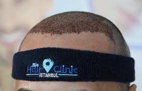 So langsam kommt bewegung auf ihren kopf. Nach Haartransplantation Haare Fallen Aus Bio Hair Clinic