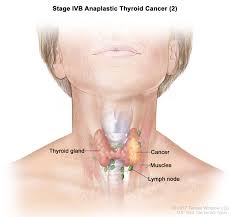It is sometimes difficult to find someone experienced in head and now, the moment your body starts showing these symptoms, you should head straight to a head and neck specialist in your area. Herenciageneticayenfermedad Thyroid Cancer Treatment Pdq Patient Version National Cancer Institute