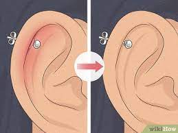 5 Ways To Heal Cartilage Piercing Bumps Wikihow