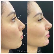 Facial Contouring