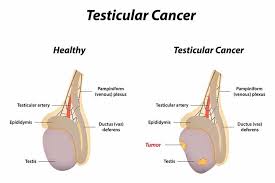 It's fairly rare and very treatable. Causes Diagnosis Treatment For Testicular Cancer