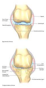 Managing the disease helps to preserve range of motion, mobility, and joint function. Arthrose Gesundheitsinformation De