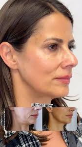2 months post #ultherapy and she can expect continued results 😍 Ultherapy  is non-surgical ultrasound technology that helps rebuild the collagen in  our skin. , Please note: the best results take time. ...