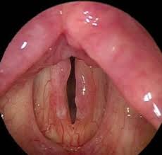 Image result for Reflux Laryngitis