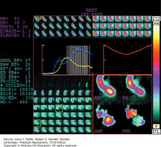 Image result for Nuclear Ventriculogram