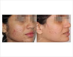 Call to schedule a consultation. Laser Hair Removal Before After Result Hairmd Pune