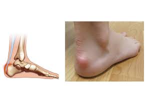 I pulled my achilles tendon very hard. Haglund S Deformity Country Foot Care