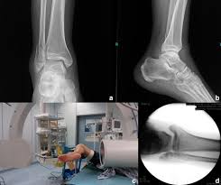 Image result for Ankle External Rotation Test