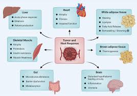 Image result for Cachexia in Cancer