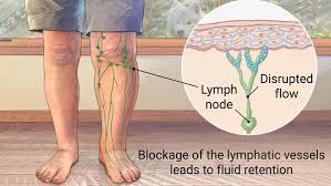 Lymphedema Ulcer - Dr. Novikov Wellness and Skin Care