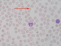 Sickle Cell Anemia Heme Medbullets Step 2 3