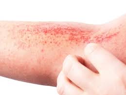 Skin Rashes Types Treatment And Prevention Skinkraft