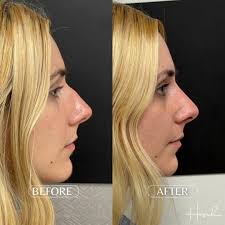 Only 1 month post op from a Minimally Invasive Surgical Rhinoplasty by Dr.  Hosch 👏 Her nose is already looking absolutely stunning!