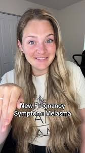 Understanding Melasma During Pregnancy