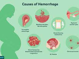 How To Know If You Re Hemorrhaging Due To A Miscarriage