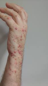 Bedbugs tend to leave straight rows of bites, unlike some other insects that leave bites here and there. Airbnb Bedbug Problem Airbnb Community