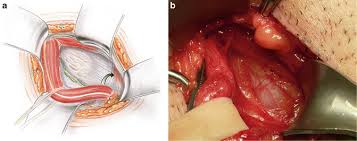 Groin injuries occur frequently in sports, especially those that involve rapid changes of direction and kicking. Surgical Treatment Of Sportsman S Groin The Minimal Repair Technique Muschaweck Repair Musculoskeletal Key