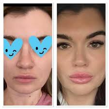 So I hear that whenever someone has a problem with their nose after surgery  that the Turkey surgeons don't care and are unresponsive to them…is this  true? And who is a surgeon