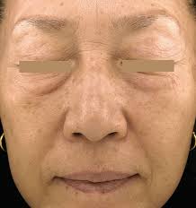 SkinTyte Before & After Gallery