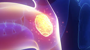 Image result for Tonsillolith