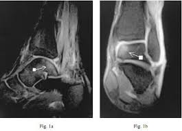 Feelings pain, hurt, and swelling are some of the other conditions, like osteoporosis or arthritis, may also cause bone or joint pain. Bone Bruise Physiopedia