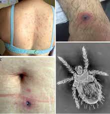 Typically these begin one to two weeks after exposure. Documentan Que Especie Causante Del Tifus De Los Matorrales En Chile Es Distinta A La De Asia Pacifico Descripcion Molecular De Una Nueva Especie De Orientia Ver Mas Aqui Https T Co Dqvawe5mvu Rickettsial Tifus