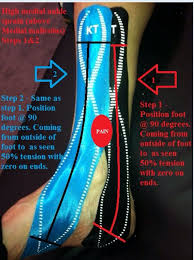 How Long Will A Sprained Ankle Take To Heal High Ankle Sprain Sprained Ankle Sprain
