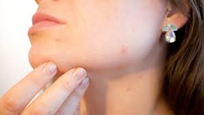 Image result for skin cancer on nose pimple