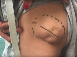 Treatment options vary, including home remedies like sitz baths with warm water and epsom salt, as well as surgery. Dr Pimple Popper Squeezes Out 50 Year Old Cyst Insider