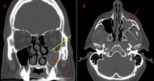 Image result for Maxillary Sinus