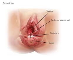 Maybe you would like to learn more about one of these? Third And Fourth Degree Perineal Tears Your Pelvic Floor