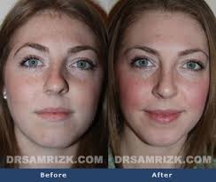 Before And After Photo Of A 24 Year Old Female Patient Who Had Rhinoplasty And Septoplasty Crooked Nose Rhinoplasty Rhinoplasty Before And After