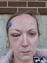 Warning: Do not click link without reading! Hey all, I had the unique  privilege of obtaining a video of my very own AVM repair surgery. I am  posting the link below for