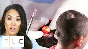 She provides services such as botox, fillers, liposuction, eye lifts and skin cancer surgery. Dr Lee Gets Sprayed By Explosive Cyst On Man S Head Dr Pimple Popper Youtube