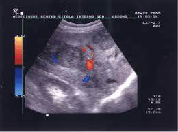 In the advanced stage, symptoms may include fever, nausea. Improved Detection Of Metastases By Color Doppler Ultrasonography