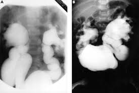 Image result for Voiding Cystourethrogram