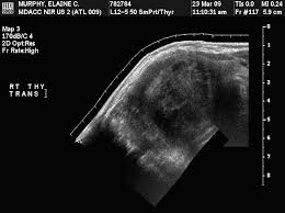 What does ovarian cancer look like on ultrasound ? Anaplastic Thyroid Cancer Diagnosis