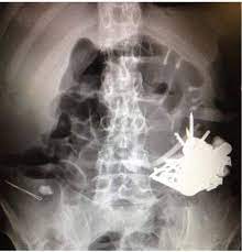 Bezoar definition, a calculus or concretion found in the stomach or intestines of certain animals, especially ruminants, formerly reputed to be an effective remedy for poison. Recurrent Gastric Metal Bezoar A Rare Cause Of Gastric Outlet Obstruction Bmj Case Reports