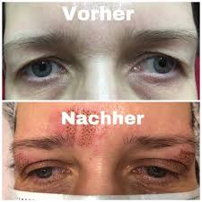 Um die wundheilung nicht zu stören und keinen druck auf die frisch gestrafften augenlider auszuüben, sollten sie für 6 wochen auf sport sowie andere körperlich anstrengende tätigkeiten verzichten. Fibroblast