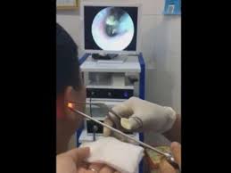 Médico filma momento em que retira borboleta de ouvido de garoto